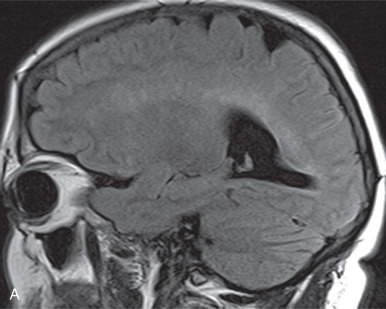 Figure 14.6, (A and B) Periventricular white matter lesions in a patient with neurosarcoidosis. Sagittal FLAIR images in a patient with neurosarcoidosis reveal prominent bilateral periventricular white matter foci of T2 hyperintensity.