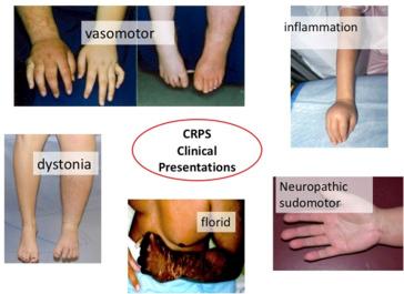 Figure 48.2, Typical clinical presentations and their predominant underlying pathologies in patients with CRPS.