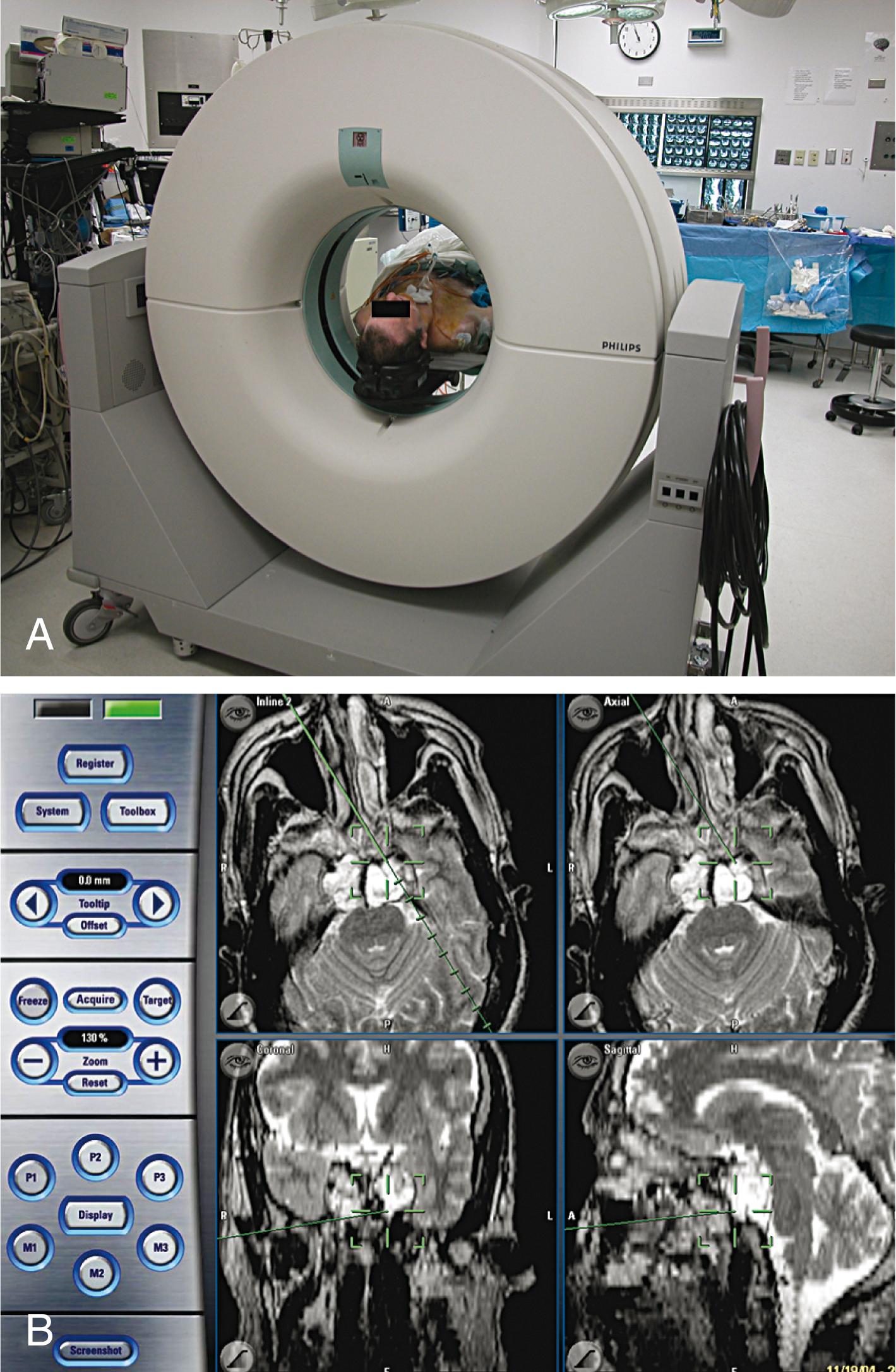 Fig. 68.11, Technologic advances in the operating room. (A) Intraoperative computed tomography scanner. (B) Computer-guided surgical navigation showing real-time location of a surgical probe tip on the preoperative magnetic resonance imaging study during resection of clival chordoma.