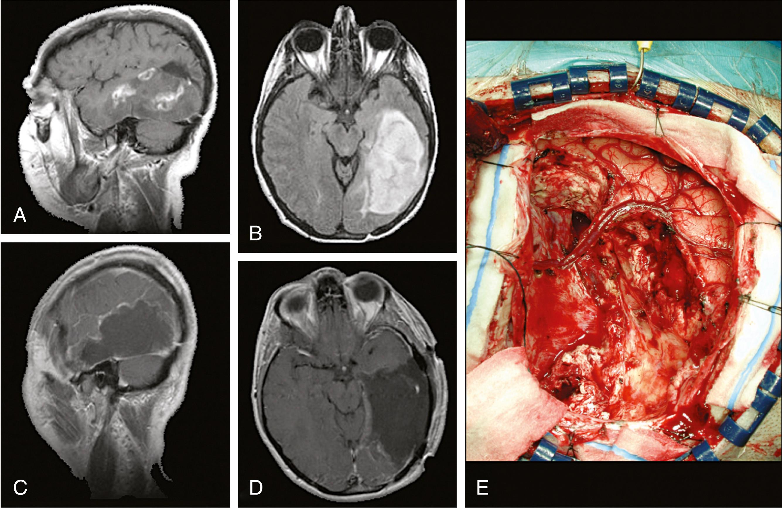 Fig. 68.13, Radiographic and intraoperative images of a patient with a left temporal anaplastic astrocytoma. (A) A partially enhancing tumor is noted in the left temporal lobe on this gadolinium-enhanced sagittal magnetic resonance imaging (MRI) study. (B) Fluid-attenuated inversion recovery sequence axial MRI shows the extent of the tumor. The postoperative gadolinium-enhanced sagittal (C) and axial (D) MRI scans show near-total resection of the tumor. (E) Intraoperative illustration of the surgical field after resection of the tumor.