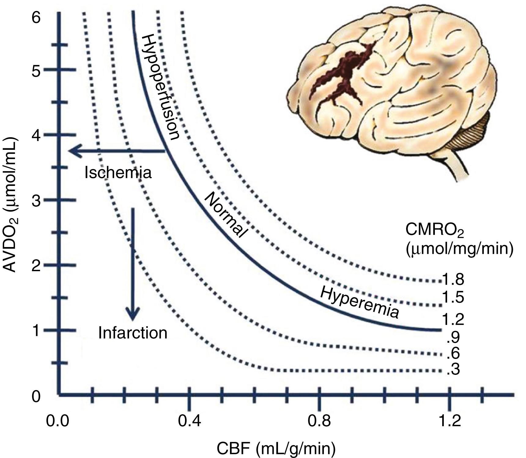 Fig. 68.2, Relationships among cerebral flow, metabolism, and oxygen extraction in normal and pathologic circumstances. (From Rangel-Castilla L, Gasco J, Nauta HJ, et al. Cerebral pressure autoregulation in traumatic brain injury. Neurosurg Focus. 2008;25:E7.) AVDO 2 , Arteriovenous oxygen difference; CBF, cerebral blood flow; CMRO 2 , cerebral metabolic rate of oxygen consumption.