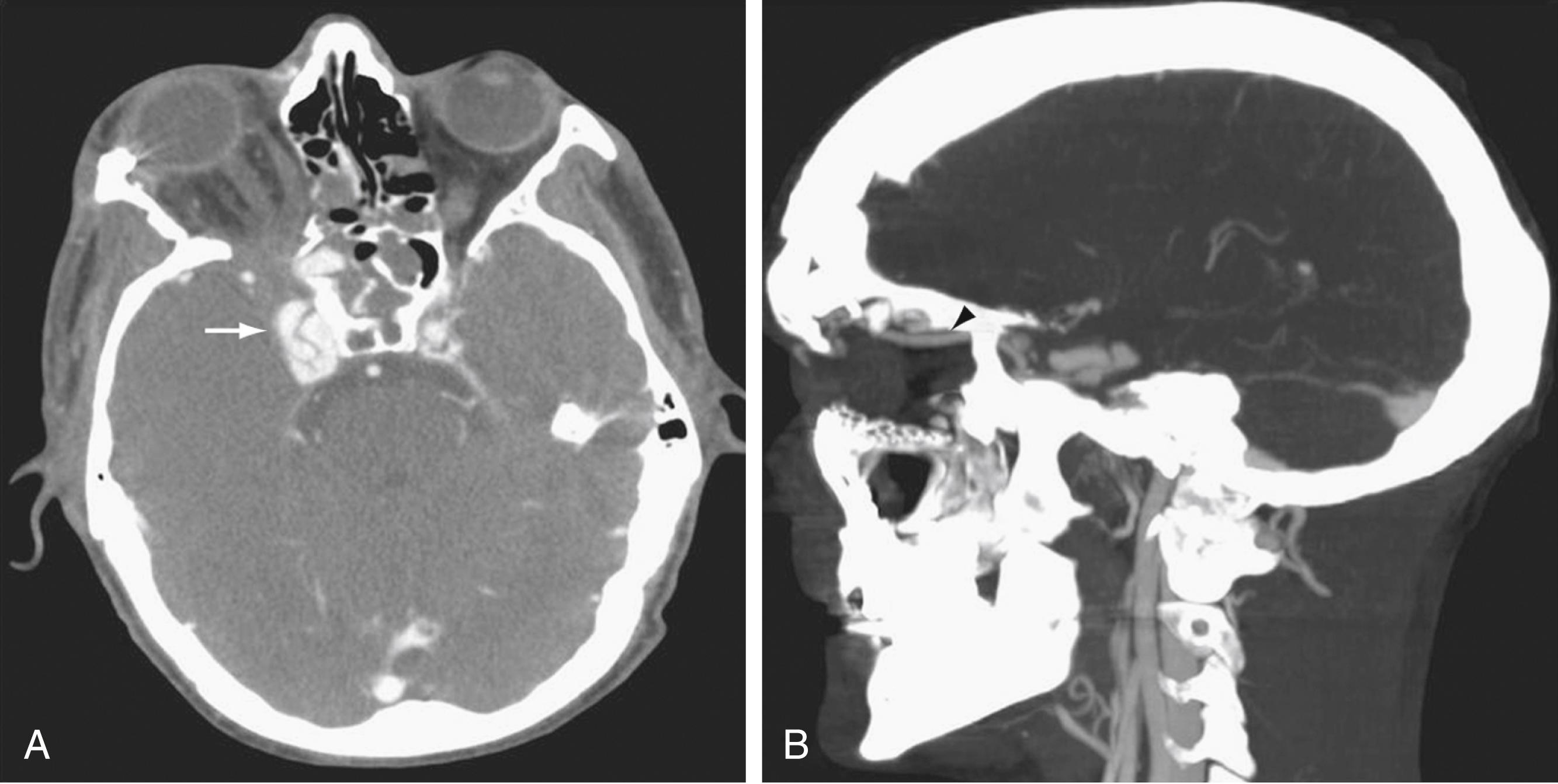 Fig. 68.5, Right internal carotid-cavernous sinus fistula (A, arrow ) with dilation of the superior ophthalmic drain (B, arrowhead ), a typical imaging finding of this pathologic process.