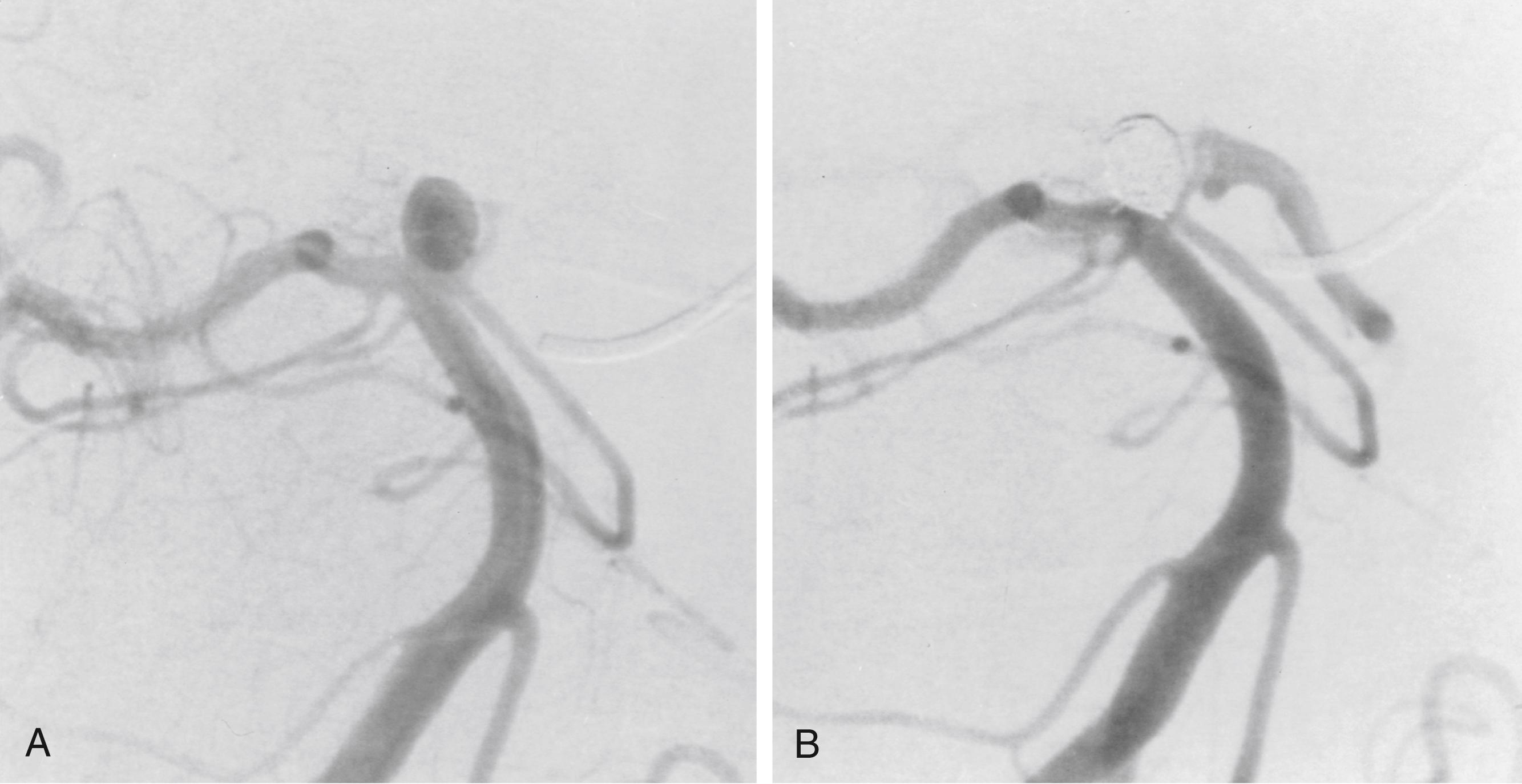 Fig. 68.8, (A) Subtraction vertebral angiogram shows a basilar tip aneurysm. (B) Subtracted vertebral angiogram after the placement of coils demonstrates excellent obliteration of the aneurysm and preservation of adjacent vessels.