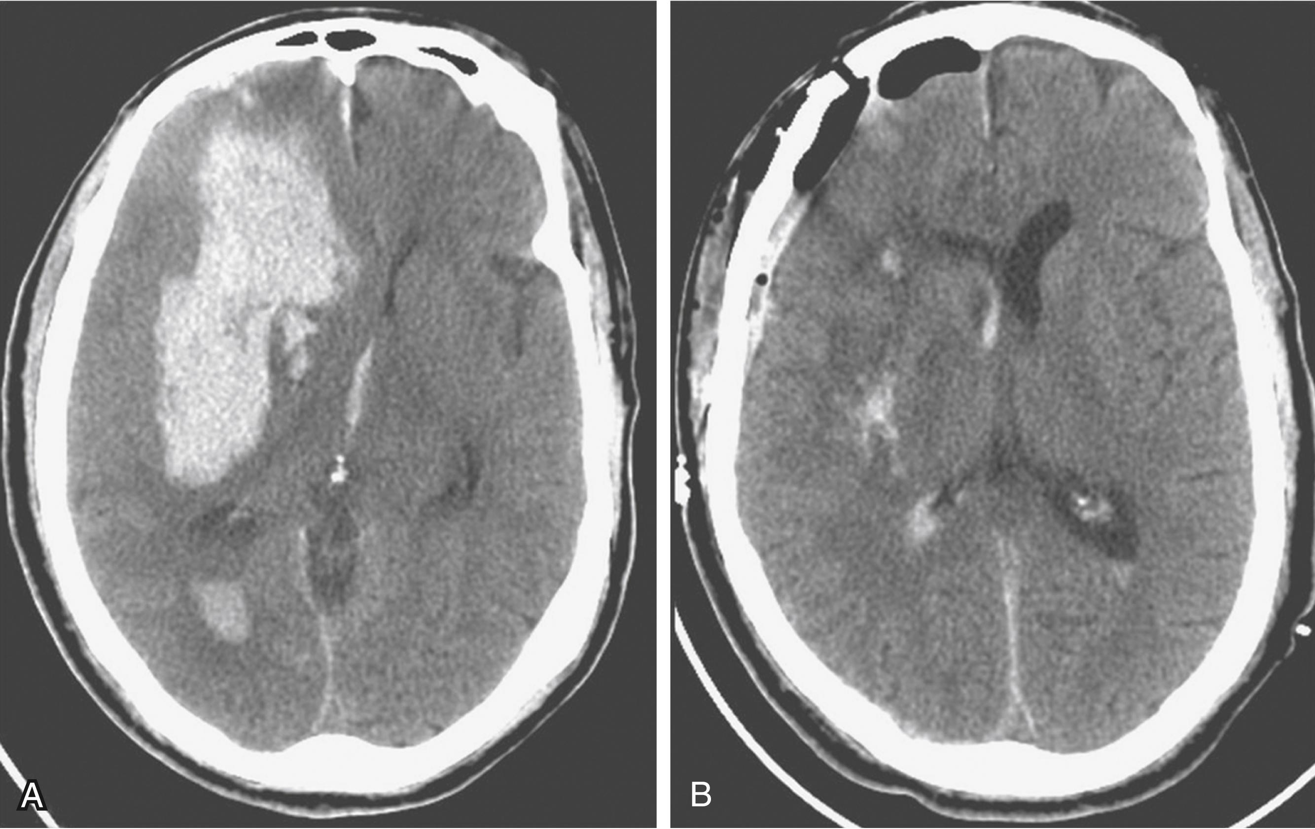 Fig. 68.9, Nonenhanced CT scan of the head. (A) Spontaneous hypertensive intracerebral hematoma in the right basal ganglia with extension to the frontal and temporal lobes. (B) Immediate postoperative CT scan shows near-total removal of the intracerebral hematoma.