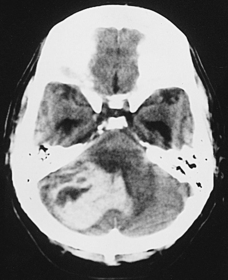 Fig. 68.10, Nonenhanced CT scan of the brain shows a large, hypertensive, intracerebellar hematoma with obstruction of the fourth ventricle and enlargement of the temporal horns, indicating obstructive hydrocephalus.
