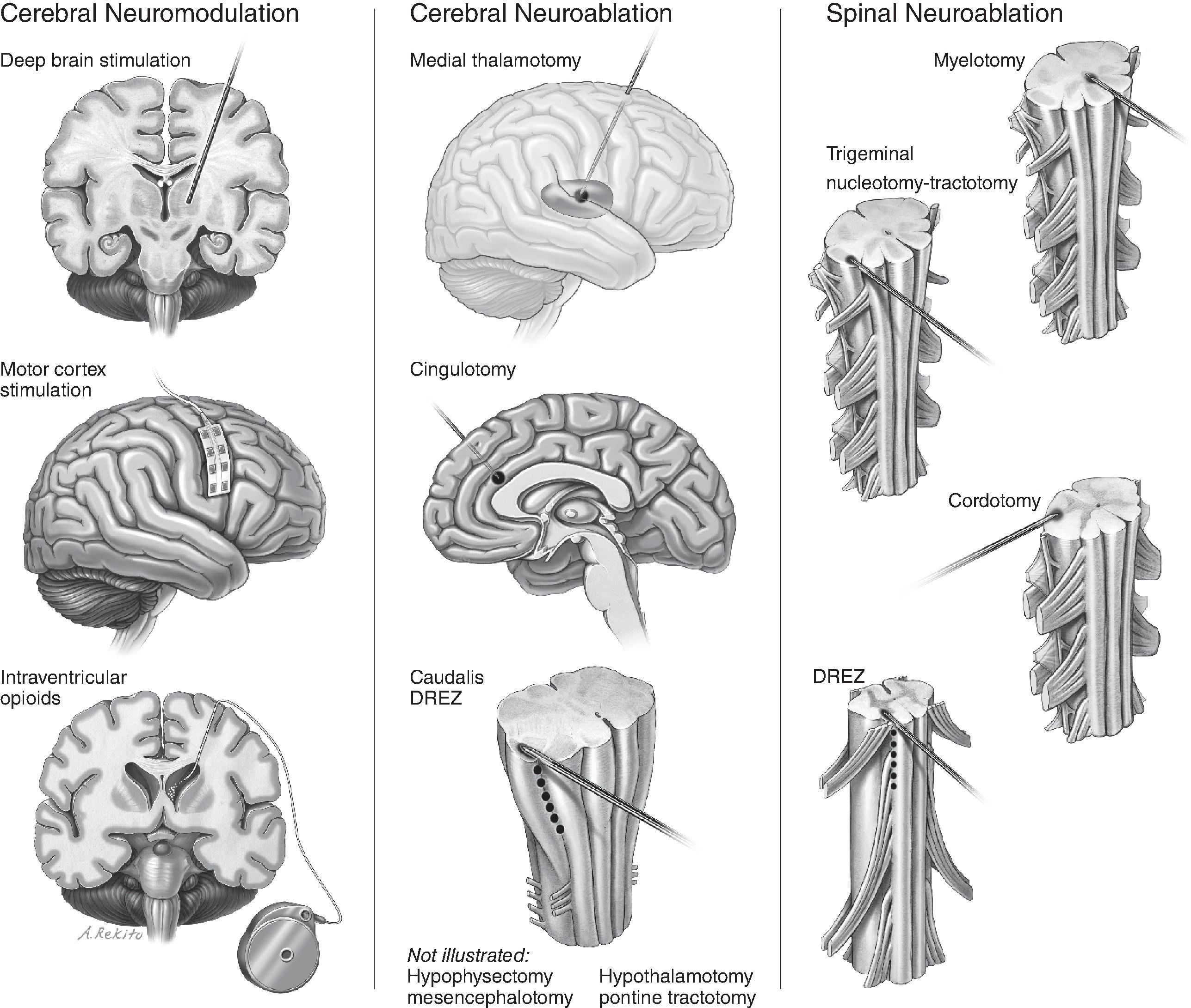 Figure 32.1, Diagrammatic representation of cerebral neuromodulation and neuroablation procedures and spinal neuroablation procedures. DREZ , Dorsal root entry zone. (Adapted with permission from Raslan AM, McCartney S, Burchiel KJ. Management of chronic severe pain: spinal neuromodulatory and neuroablative approaches. Acta Neurochir Suppl . 2007;97:33-41. With kind permission from Springer Science and Business Media.)