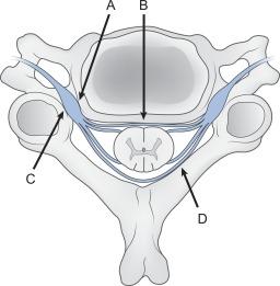 Fig. 21.11, Cervical spondylosis. 12 Common sites of pathology that may result in compression of the spinal cord or nerve root: A, Lateral disk herniation or osteophyte hypertrophy; B, central disk herniation or osteophyte formation; C, facet joint osteophyte; D, hypertrophy of the ligamentum flavum.