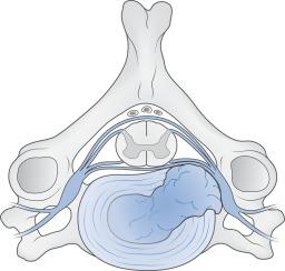 Fig. 21.12, Cervical radiculopathy caused by foraminal stenosis from a posterolateral herniation of the nucleus pulposus with compression of the exiting nerve root.