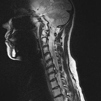 Fig. 21.13, Cervical disk herniation and anterior cervical diskectomy and fusion (ACD & F). A 41-year-old woman presented with pain in the neck that radiated to the left hand and fingers. This sagittal T2-weighted magnetic resonance image shows a 6-mm disk protrusion at C6–C7.