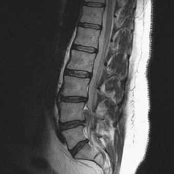 Fig. 21.14, Lumbar disk herniation. A 42-year-old man complained of low back pain with radiation to the left lower extremity. This sagittal T2-weighted magnetic resonance image shows a large disk herniation at L4–L5 with the nucleus pulposus extruding 2 cm cephalad into the ventral epidural space.