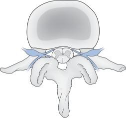 Fig. 21.15, Axial view of a lumbar vertebra. Characteristic hypertrophic degenerative changes can be seen in the central canal, facet joints, and lateral recesses.