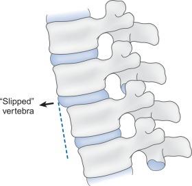 Fig. 21.16, Degenerative spondylolisthesis with anterior “slippage” of the cephalad vertebra over the vertebra below it.