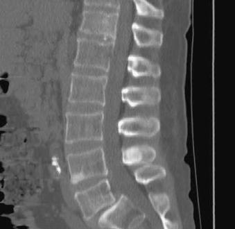 Fig. 21.17, Spondylolisthesis. A 48-year-old man presented with bilateral lower extremity numbness. This midsagittal computed tomography scan of the lumbar spine shows a 1-cm anterolisthesis of L5 on S1.