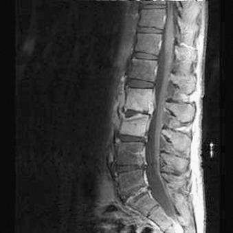 Fig. 21.18, Vertebral osteomyelitis. A 50-year-old male intravenous drug abuser presented with low back pain that had lasted for 1 month. This sagittal T1-weighted magnetic resonance image of the lumbar spine obtained after contrast administration shows edema and enhancement of the L2 and L3 vertebral body marrow and loss of height and signal in the L2–L3 disk space.