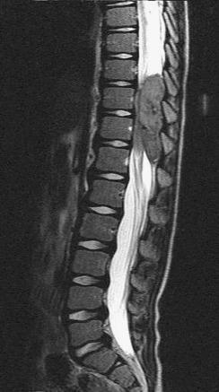 Fig. 21.19, Ewing’s sarcoma. A sagittal pre-contrast T2-weighted magnetic resonance image shows a 5.4 cm long by 1.6 cm heterogeneously enhancing mass located in the dorsal epidural space from T9 to T12 that is severely compressing the spinal cord.