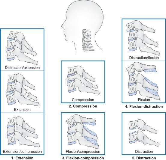 Fig. 21.21, Mechanistic classification of cervical spinal injuries. This illustration of the spectrum of cervical spine injuries is based on the mechanistic classification proposed by Allen and colleagues. 250