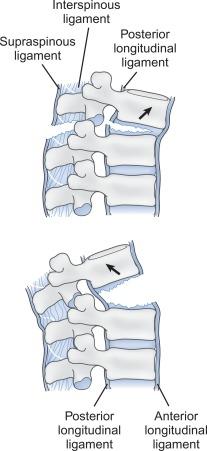 Fig. 21.22, Top, Distracted vertebral body with disrupted posterior longitudinal ligament occurring after hyperflexion injury. Bottom, Distracted vertebral body with disrupted anterior longitudinal ligament occurring after hyperextension injury (arrows show direction of forces).