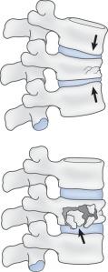 Fig. 21.23, Top, Vertebral compression fracture (arrow). Bottom, Vertebral burst fracture (arrow) with retropulsion of bone fragments posteriorly into the vertebral canal.