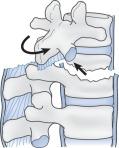 Fig. 21.24, Rotation injury showing dislocated articular facts (small arrow).