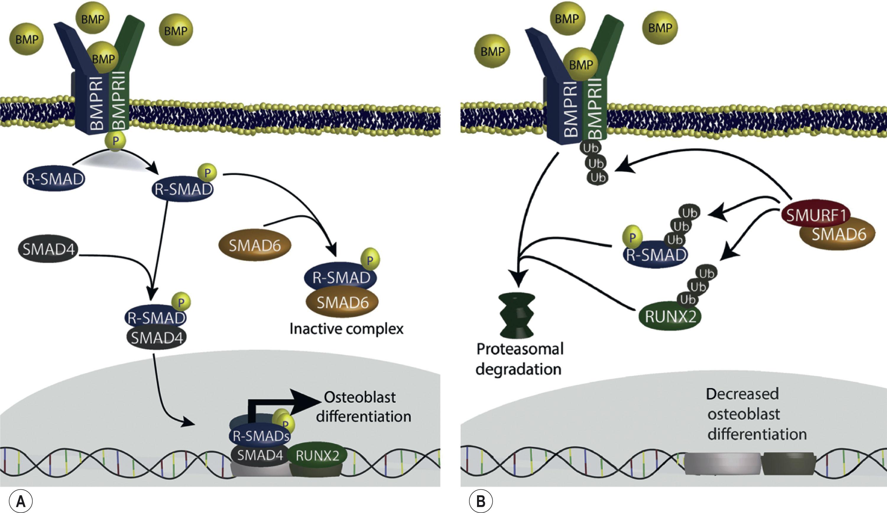 Figure 25.4.1, BMP signaling pathway in craniosynostosis. BMP receptors are stimulated by BMP ligands, inducing phosphorylation of receptor-SMADs (R-SMAD). Phosphorylated R-SMADs are either shuttled into the nucleus by means of SMAD4 to act in conjunction with transcription factors to induce transcription of genes that promote osteoblast differentiation and bone formation, or sequestered by an inhibitory SMAD. The combination of increased expression of BMP2 and loss of signaling inhibitor SMAD6 is thought to underlie the pathogenesis of craniosynostosis in a fraction of cases. BMP, Bone morphogenetic protein; SMAD, Suppressor of Mothers against Decapentaplegic; SMURF, Smad ubiquitin regulatory factor; RUNX, Runt-related transcription factor.