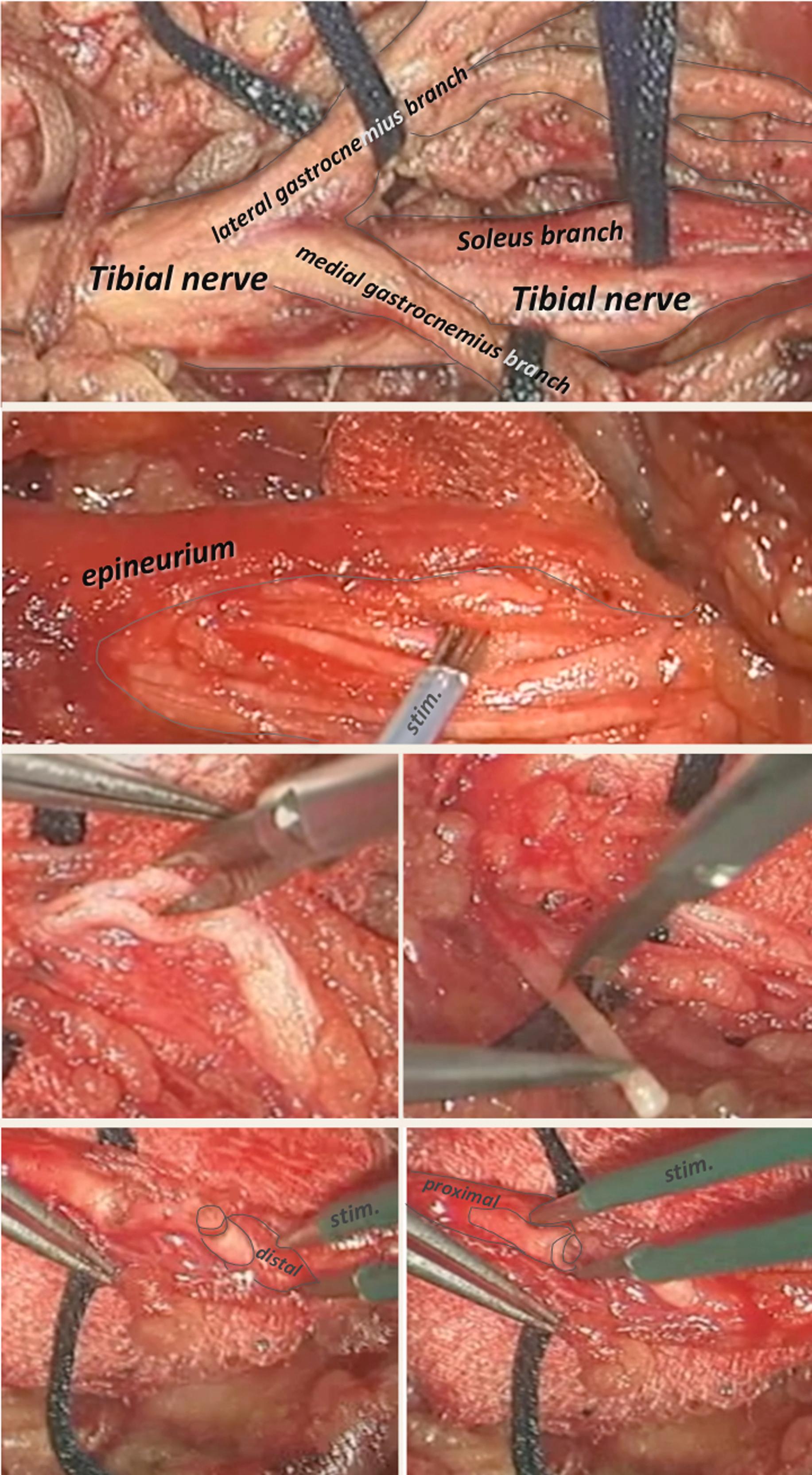 Figure 35.3, General principles of peripheral neurotomy. Microsurgical views of steps of neurotomy – at level of the tibial nerve, as an example. First row : Dissection of trunk of the tibial nerve with branches destinated for medial and lateral gastrocnemius and soleus muscle. Fascicles enclosed in epineurium. Second row : Fascicles of tibial trunk exposed after opening of epineurium, and individual stimulation with a (tripolar) electrical probe to identify the motor fascicles corresponding to the flexor digitorum muscles. Third row : Sectioning of a selected fascicle among several for a length of 5 mm to avoid regrowing of fibers (left). Microsurgical view of the resection of one fascicle, one of the two constituting the targeted motor nerve (right), Fourth row : Stimulation distal to site of resection giving maximal muscular response (left). Stimulation proximal to site of resection giving muscular response proportional to the quantity of resection (right).