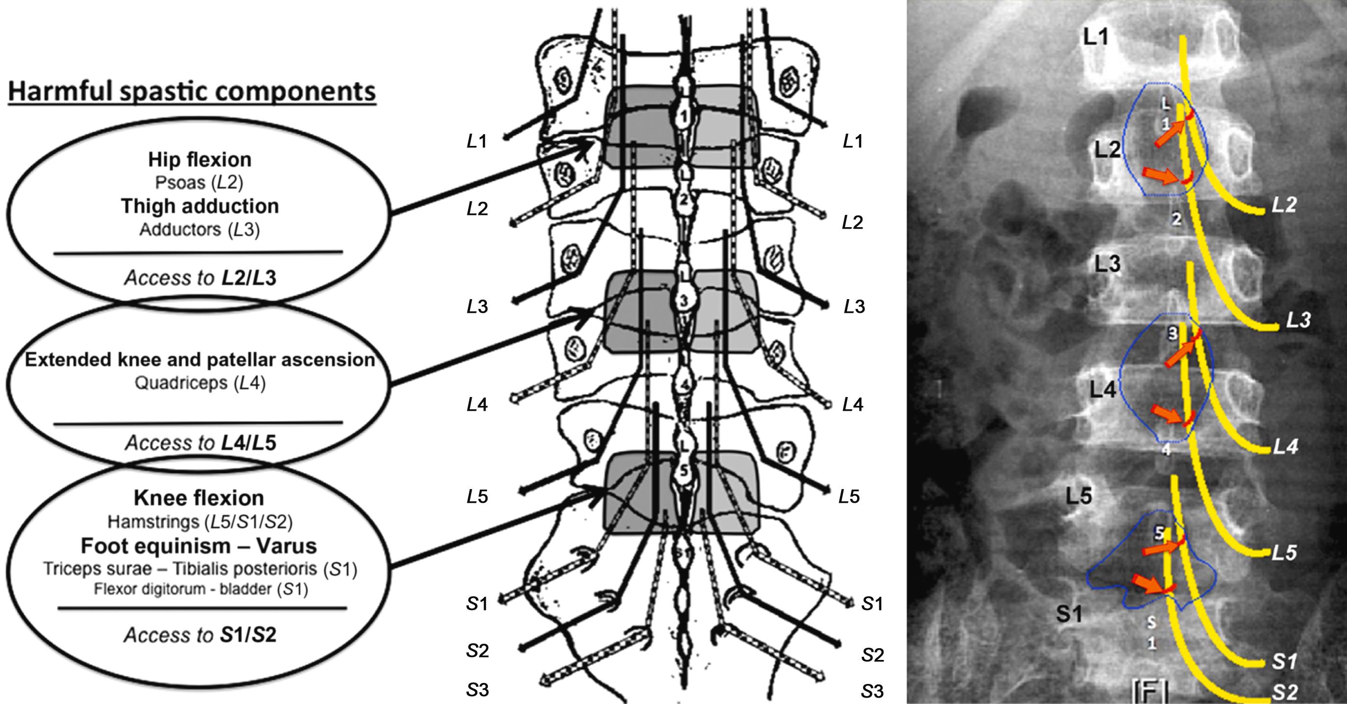 Figure 35.4, (Left) Schematic drawing of IL vertebral levels where selected roots can be targeted for DRh: at L1–L2 for roots L2/L3; at L2–L3 for roots L3/L4; at L3–L4 for roots L4/L5; and at L5–S1 for roots S1/S2. The IL spaces to be opened are determined according to the preoperative plan for root sectioning (i.e., tailored operation). The gray squares represent IL vertebral levels where targeted roots are approached intradurally in this illustration. Roots L2 and L3 were targeted for treatment of spastic hip flexion and thigh adduction at the L1–L2 IL space. Root L4 was targeted for treatment of extended knee with patellar ascension at the L3–L4 IL space. Root S1 was targeted at the L5–S1 IL space for treatment of spastic foot in equinism, varus, and spastic hamstrings. (Right) Post-operative X-ray (anteroposterior view) showing the KIDr approach through enlarged interlaminar spaces (with respect of lamina and spinous processes). Each enlarged fenestration, on midline, allows to access two roots—on each side— Roots L2 and L3 were targeted at the L1–L2 IL space, for treatment of spastic hip and thigh in flexion–adduction. Roots L4 and L5 were targeted at the L3–L4 IL space, for treatment of spastic quadriceps with patella ascension. Roots S1 and S2 were targeted at the L5–S1 IL space, for treatment of spastic foot in equinism and spastic hamstrings. The red hemicircular arc line represents the intradural exit of the ventral root/intradural entry of the dorsal root to or from the corresponding dural sheath. DRh , Dorsal rhizotomy; KIDr , keyhole interlaminar dorsal rhizotomy; IL , interlaminar.