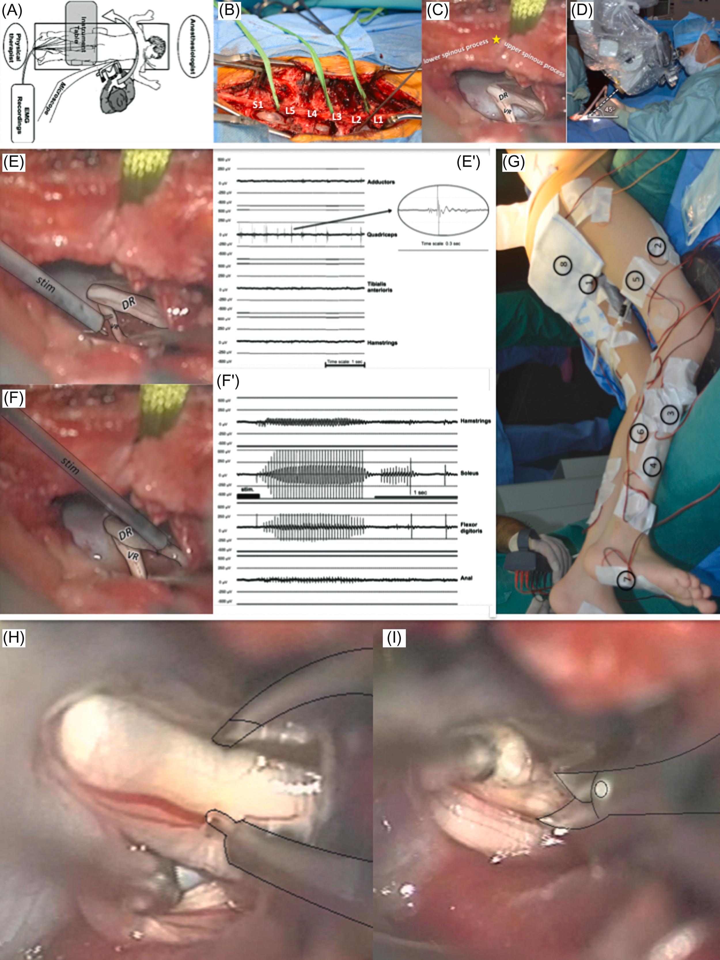 Figure 35.5, KIDr: (A) schematic drawing of the organization of the operating room and surgical team. The curved arrow indicates that the surgeon changes position and side to obtain access to the targeted root. (B) Exposure of L1–S1 laminae on both sides, with L1–L2, L3–L4, and L5–S1 IL fenestrations. (C) At each level to be fenestrated the inferior two-thirds of upper lamina and the superior three-fourths of the lower lamina are resected on midline and flavum ligament removed so that dura and arachnoid can be opened (on midline) over 20–30 mm in height. Note that the spinous processes and interspinous ligaments are respected. *Exposure and individualization of the VRs and DRs at the exit from or entry to their dural sheath. (D) Surgeon’s view is an (±45 degrees) oblique trajectory, which passes underneath the arch formed by the (respected) interspinous ligament, so that the contralateral roots be accessed at exit to (for VR)/entry from (for DR) corresponding dural sheaths. Two radicular levels can be reached per IL fenestration, one upward and the other downward. (E, G, J and K) Microsurgical steps per radicular level are as follows. (E) Stimulation of VR, at 2 Hz and 200 μΑ, Anatomic mapping for topographic identification of the radicular levels. In this illustrative case, stimulation (at 2 Hz and 200 μA) of the L4 VR elicits an EMG response predominantly in the quadriceps muscular group. Inset: The graphical element corresponds to magnification of a direct EMG response (time scale: 0.3 second). (F) Stimulation of DR at 50 Hz and 1 mA. Anatomy is characteristic, with the VR being situated anteriorly and the DR posteriorly. The DR is approximately twice as thick as the VR. [Physiological testing for estimating the excitability of the root–spinal cord circuitry.] In this illustrative case, stimulation (at 50 Hz and 1 mA) of the S1 DR elicits an abnormal EMG response: (1) sustained that is lasting after the cessation of the stimulation and (2) spreading that is not only at the level of the soleus muscle, but also outside the corresponding S1 myotome. Note the spreading of response to the hamstrings, flexor digitoris, and anal sphincter muscles. (G) Placement of intramuscular electrodes. Patient is installed in prone position on bolsters–cushions in order to minimize the lumbar lordosis and thus open the interlaminar spaces, while avoiding thoracic and abdominal compression and preserving abdominal venous return. All pressure points are padded to prevent eventual ulcers. Sixteen (8×2) intramuscular needle electrodes are inserted in lower limbs bilaterally. (H and I) According to preoperative chart and adjustments from monitoring, coagulation and final sectioning of DR is performed (in this case: two-thirds of the dorsal rootlets of this root). DR , Dorsal root; EMG , electromyogram; IL , interlaminar; KIDr , keyhole interlaminar dorsal rhizotomy; VR , ventral root.