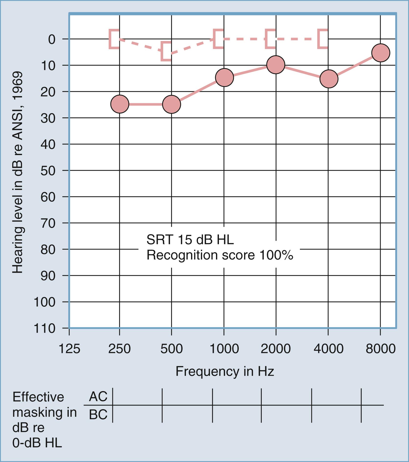 Figure 16.5, Air conduction (AC; red circles) and bone conduction (BC; square open brackets) pure-tone threshold sensitivities are plotted as a function of frequency in conductive hearing loss caused by otitis media (right ear). The speech reception threshold (SRT) is expressed as hearing level (HL), and the speech recognition score is the percentage of correct responses. ANSI, American National Standards Institute.