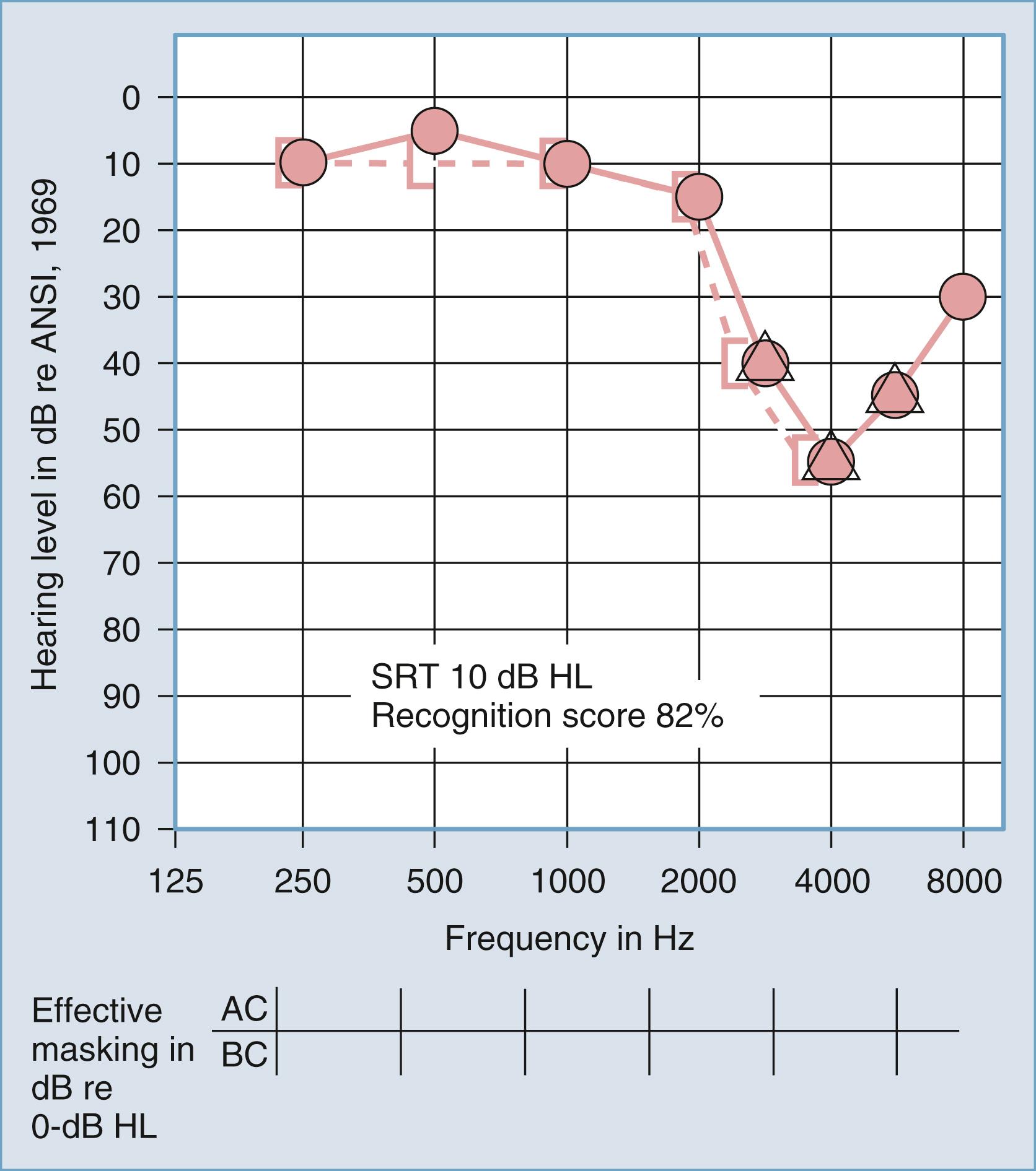 Figure 16.6, Air conduction (AC; red circles) and bone conduction (BC; square open brackets) pure-tone threshold sensitivities are plotted as a function of frequency in sensorineural hearing loss caused by exposure to industrial noise (right ear). Thresholds with masking are also indicated (triangles). The speech reception threshold (SRT) is expressed as hearing level (HL), and the speech recognition score is the percentage of correct responses. ANSI, American National Standards Institute.