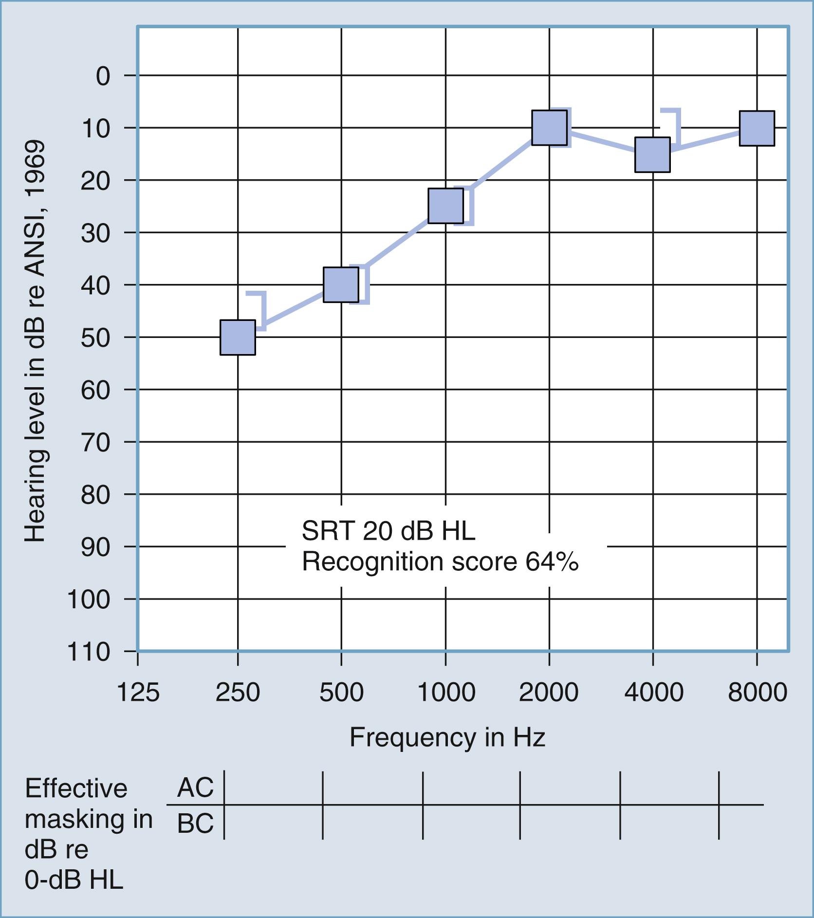 Figure 16.8, Air conduction (AC; blue squares) and bone conduction (BC; square open brackets) pure-tone threshold sensitivities are plotted as a function of frequency in sensorineural hearing loss caused by Ménière disease (left ear). The speech reception threshold (SRT) is expressed as hearing level (HL), and the speech recognition score is the percentage of correct responses. ANSI, American National Standards Institute.