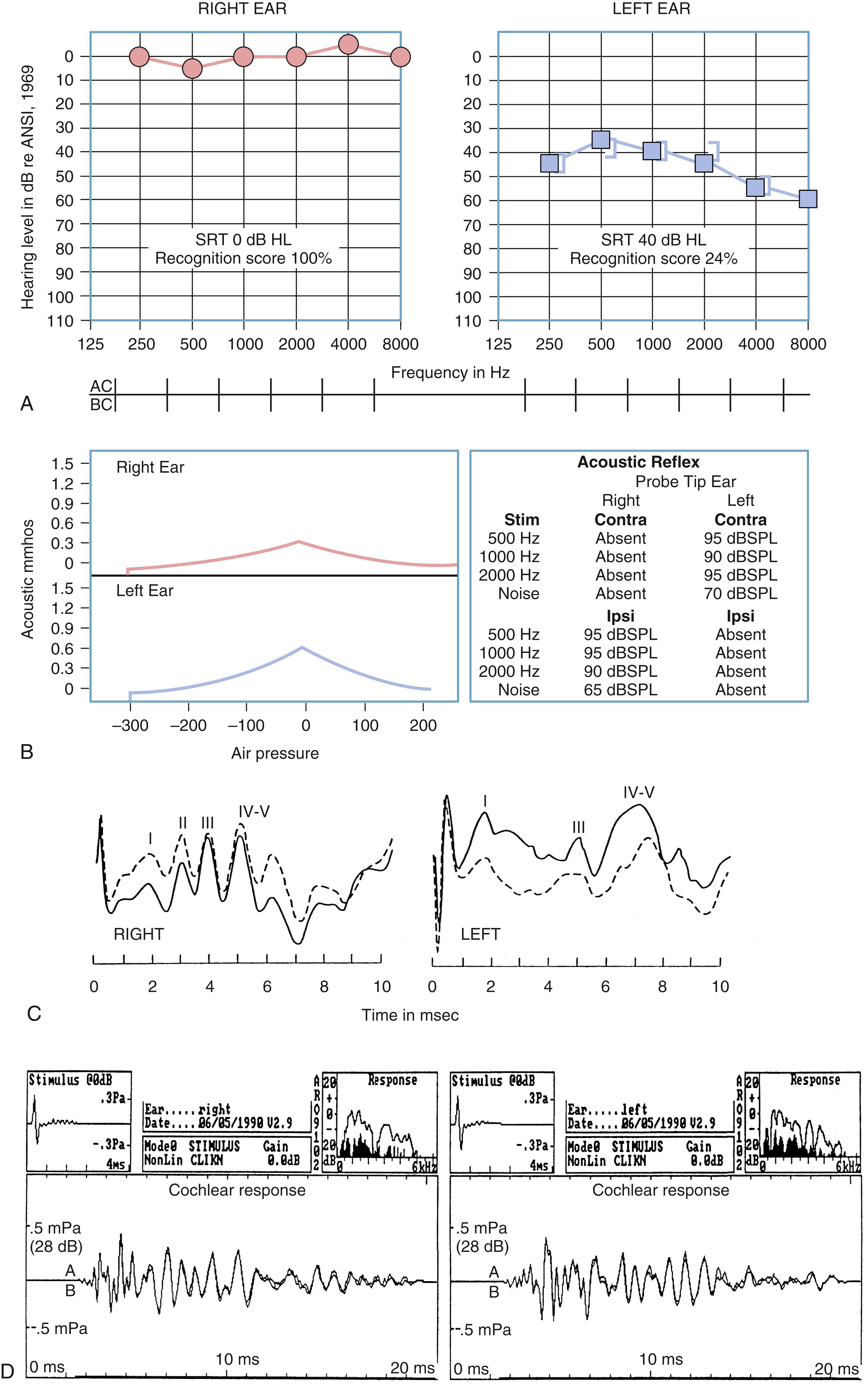 Figure 16.9, Bilateral auditory test results from a patient with unilateral (left ear) acoustic neuroma extending into the cerebellopontine angle.