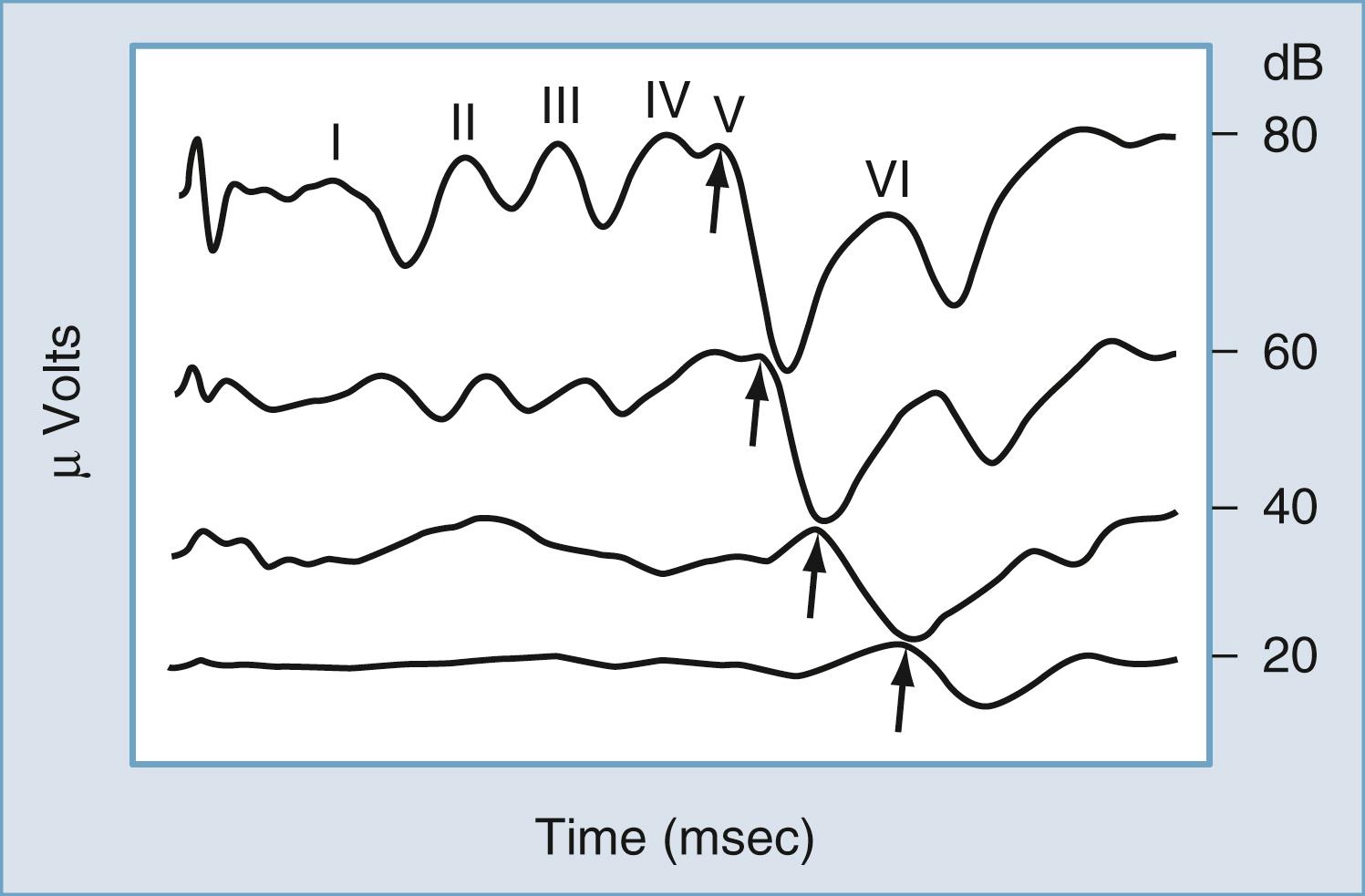 Figure 16.10, Wave latency results for auditory brainstem evoked responses, graphed as a function of decreasing stimulus level. The time window is 10 msec. Arrows indicate identification of wave V latency.