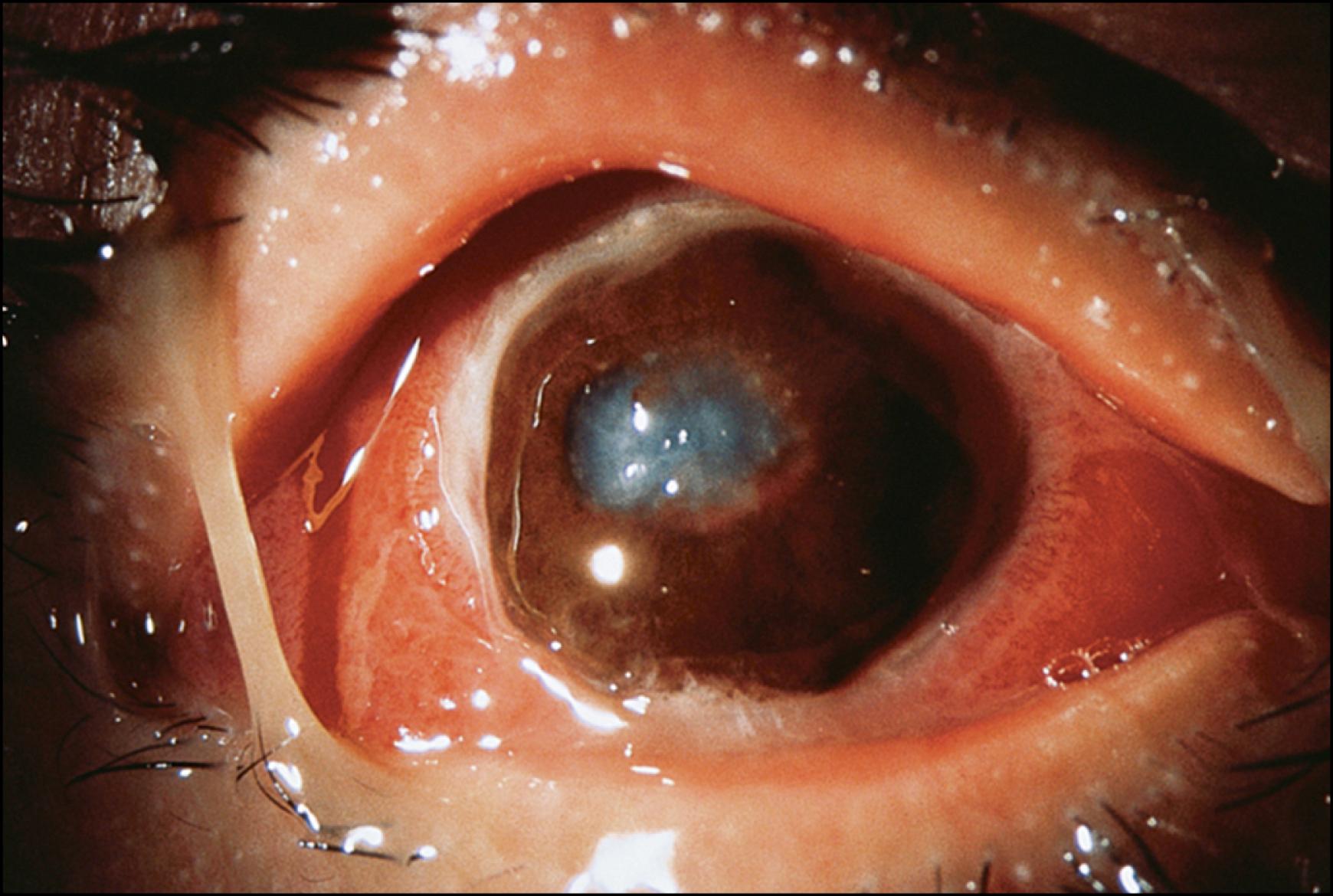 Fig. 88.1, Complete corneal necrosis secondary to topical anesthetic abuse.