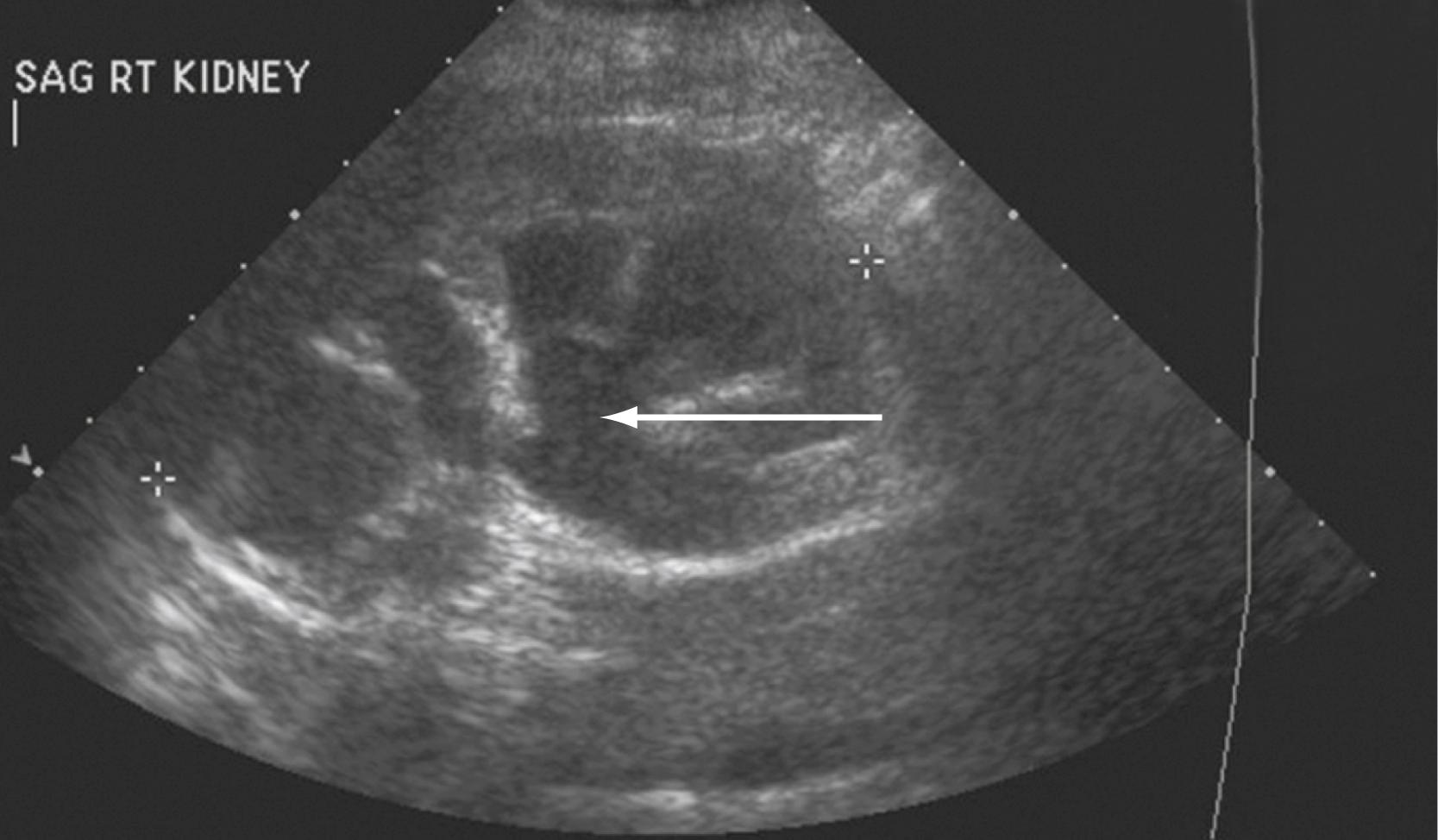 Figure 17.6, Renal ultrasound scan demonstrating hydronephrosis in a patient with a neurogenic bladder and poor bladder compliance. The arrow identifies areas of distention of the renal pelvis, calyces, and proximal ureter. Note the preserved renal parenchyma surrounding the calyces, a finding suggesting preserved renal function.