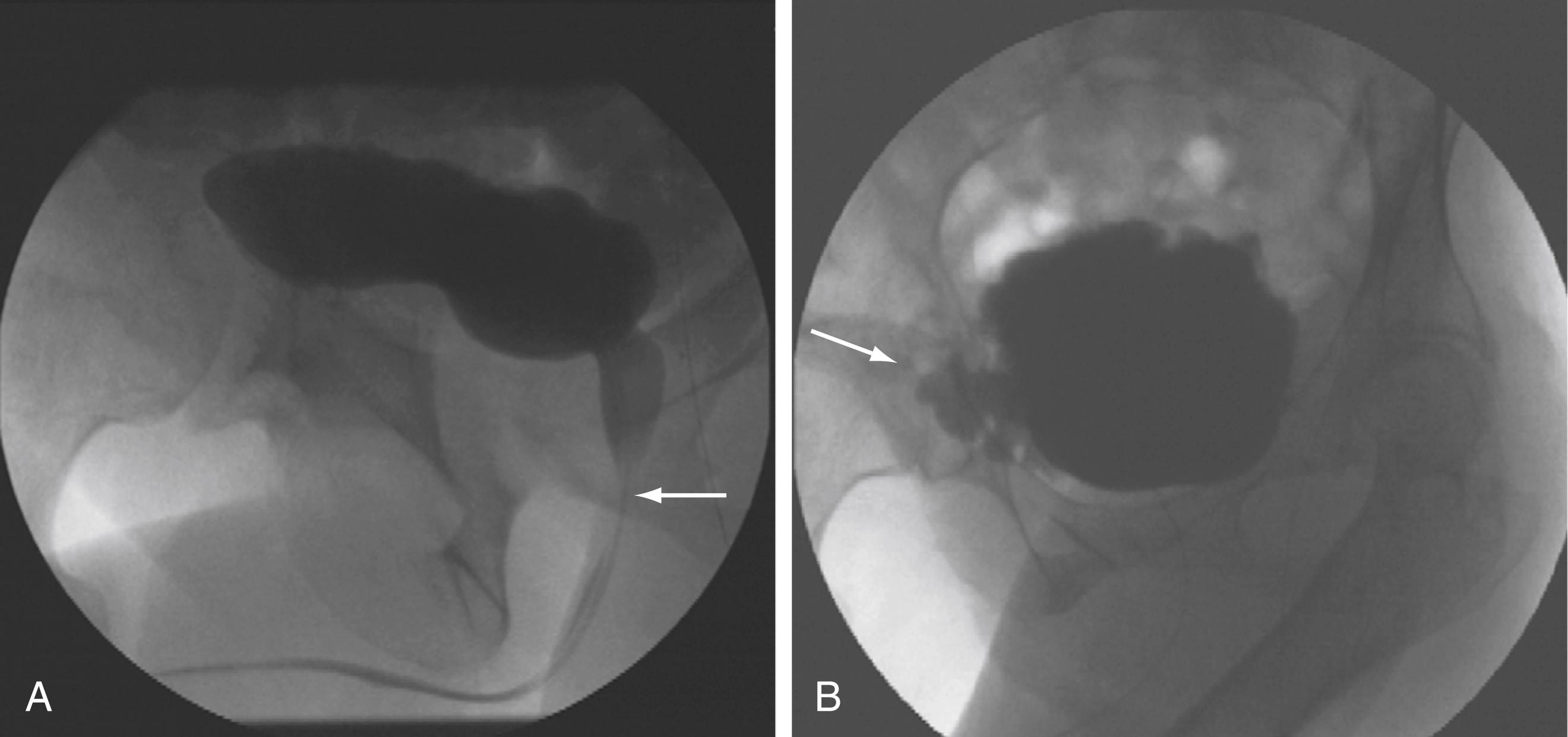 Figure 17.7, Voiding cystourethrogram .