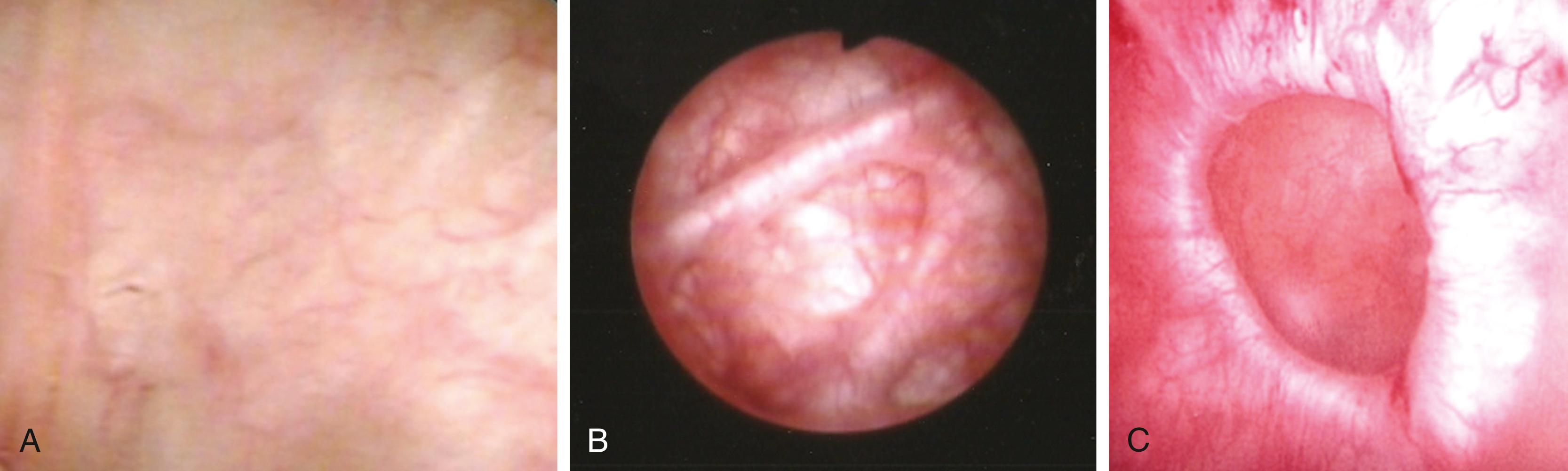 Figure 17.8, Images from cystoscopy of the bladder mucosa.