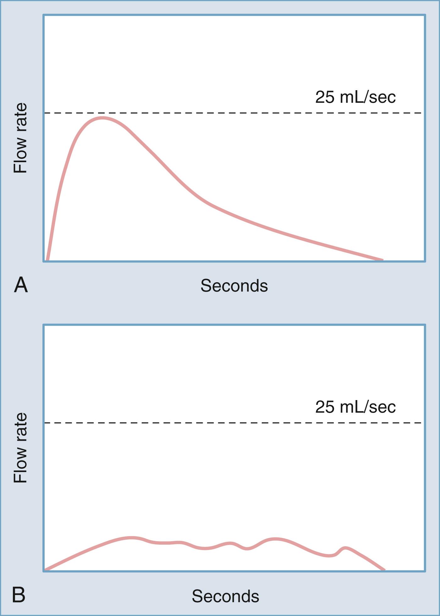 Figure 17.9, Uroflowmetry tracings.