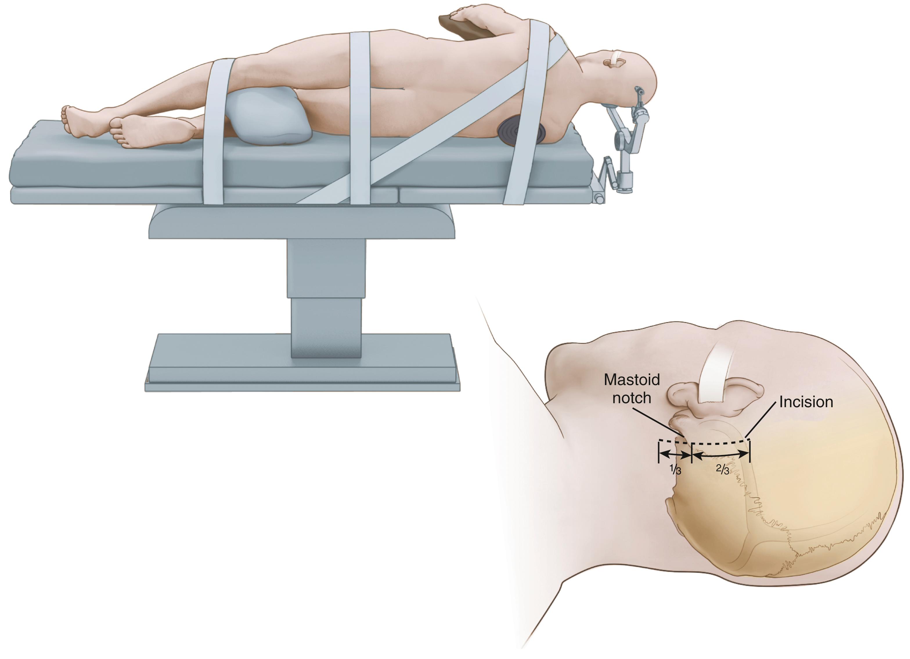 FIGURE 116.1, Patient positioning. Lateral positioning on the operating table for left-sided trigeminal nerve decompression.