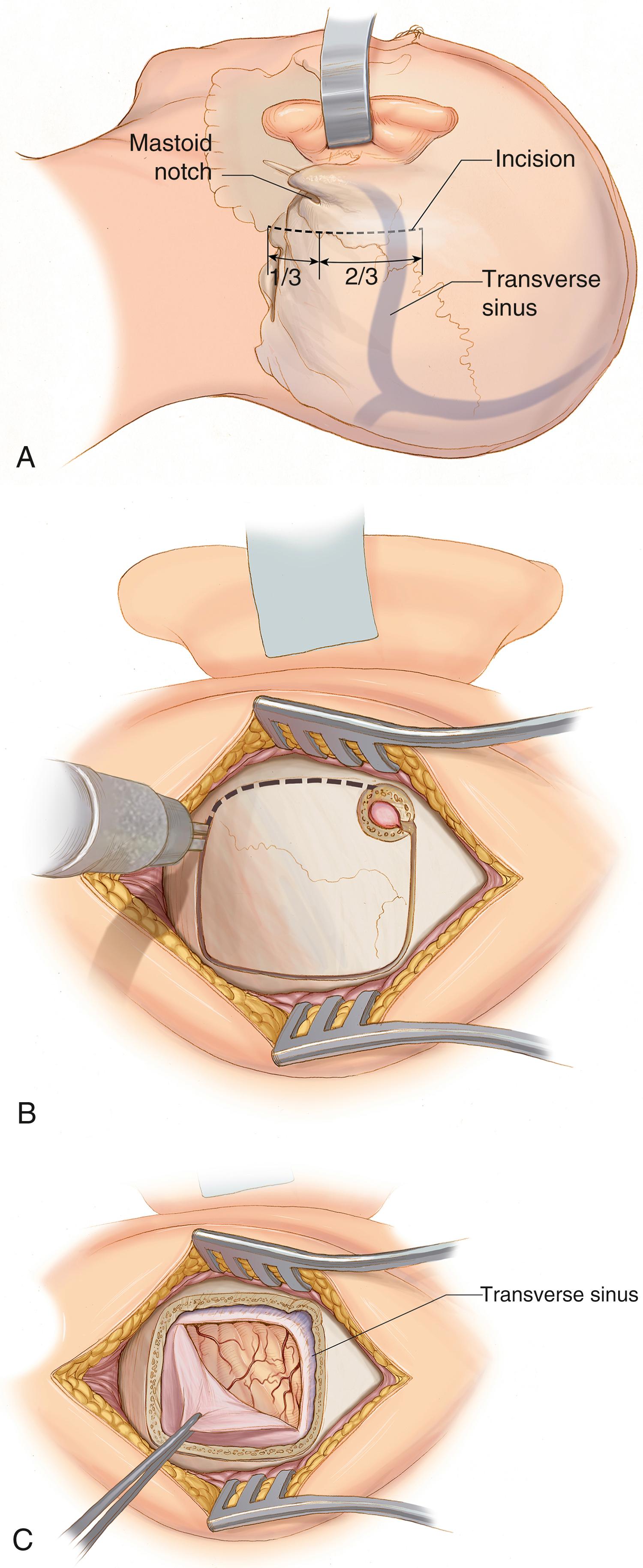 FIGURE 116.2, Lateral suboccipital (retrosigmoid) approach. (A) Dotted line indicates the incision with one-third of the incision being below the mastoid notch and two-thirds above the notch. (B) Location of craniotomy with the superior and lateral edge at the transverse-sigmoid junction. (C) An L-shaped dural incision is fashioned, parallel to the transverse and sigmoid sinuses.