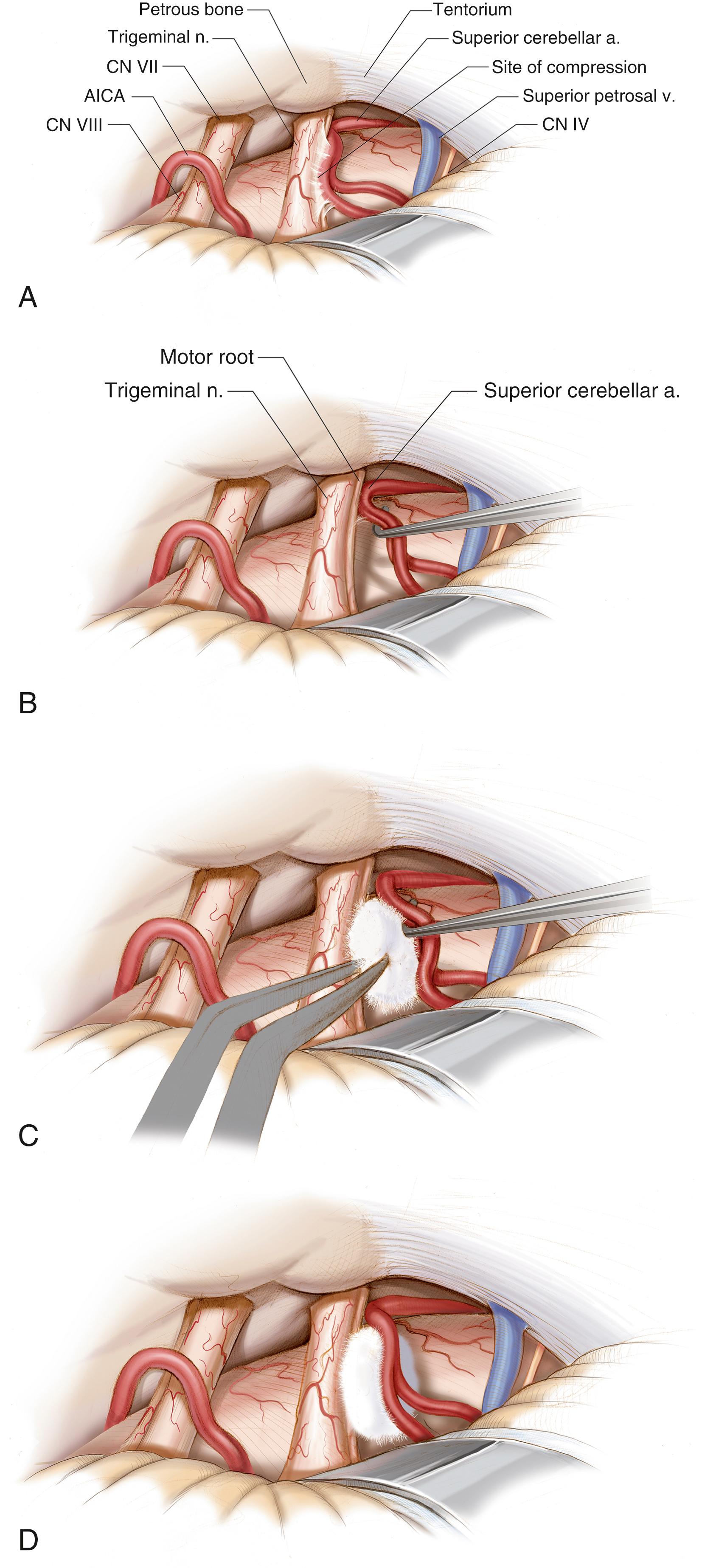 FIGURE 116.3, Microvascular decompression of the trigeminal nerve. (A) An overview of the most common pathology reveals the superior cerebellar artery (SCA) compressing the root entry zone of the trigeminal nerve (CN V). (B) Meticulous dissection is able to separate the SCA from the nerve. (C) Displacement of the artery from the nerve is maintained with Teflon or Ivalon pledgets. (D) Adequate decompression following surgery. AICA , Anterior inferior cerebellar artery; CN , cranial nerve.