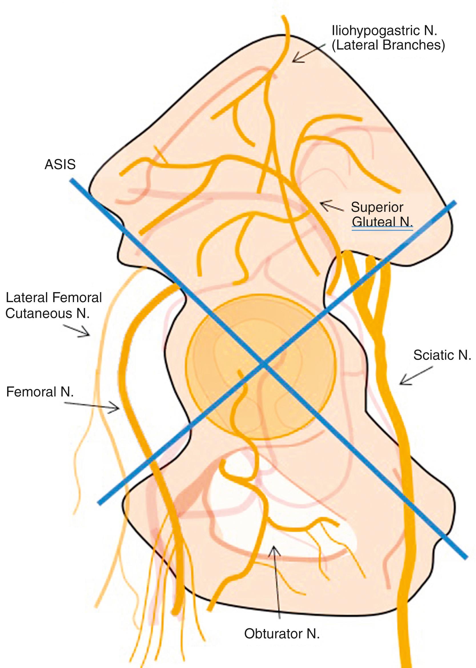 Fig. 20.1, Diagram of the hemipelvis demonstrating the major nerves at risk. ASIS, anterior superior iliac spine.