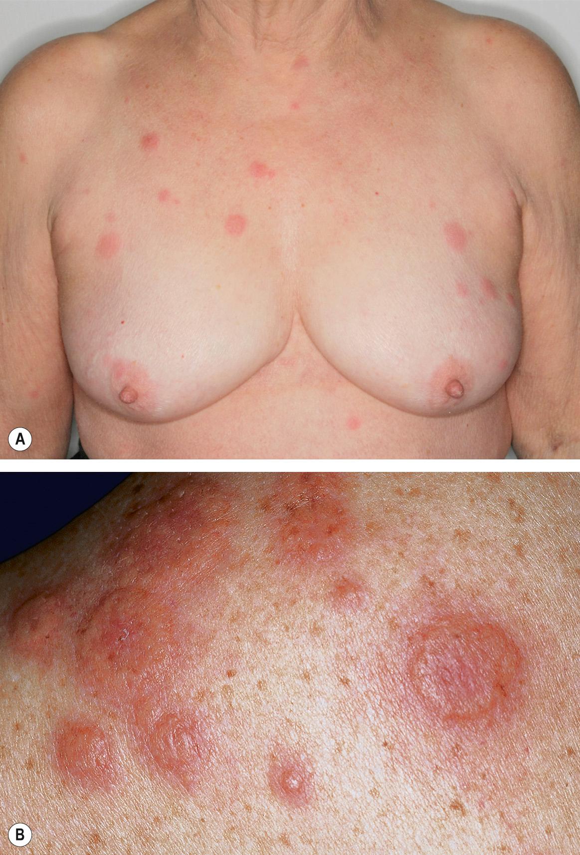 Fig. 26.2, Sweet syndrome.