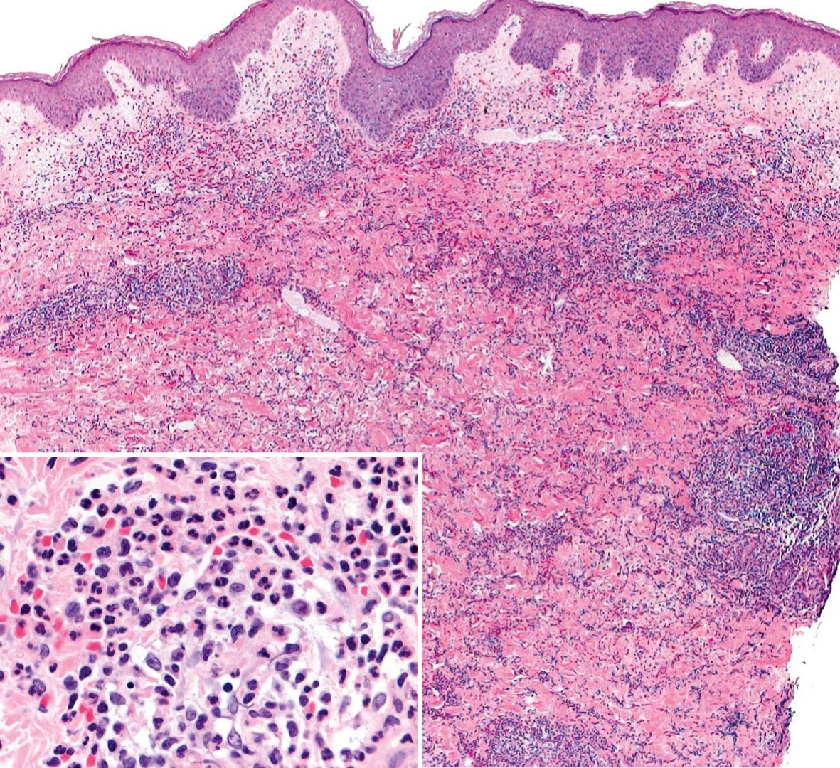 Fig. 26.5, Sweet syndrome – histologic features.