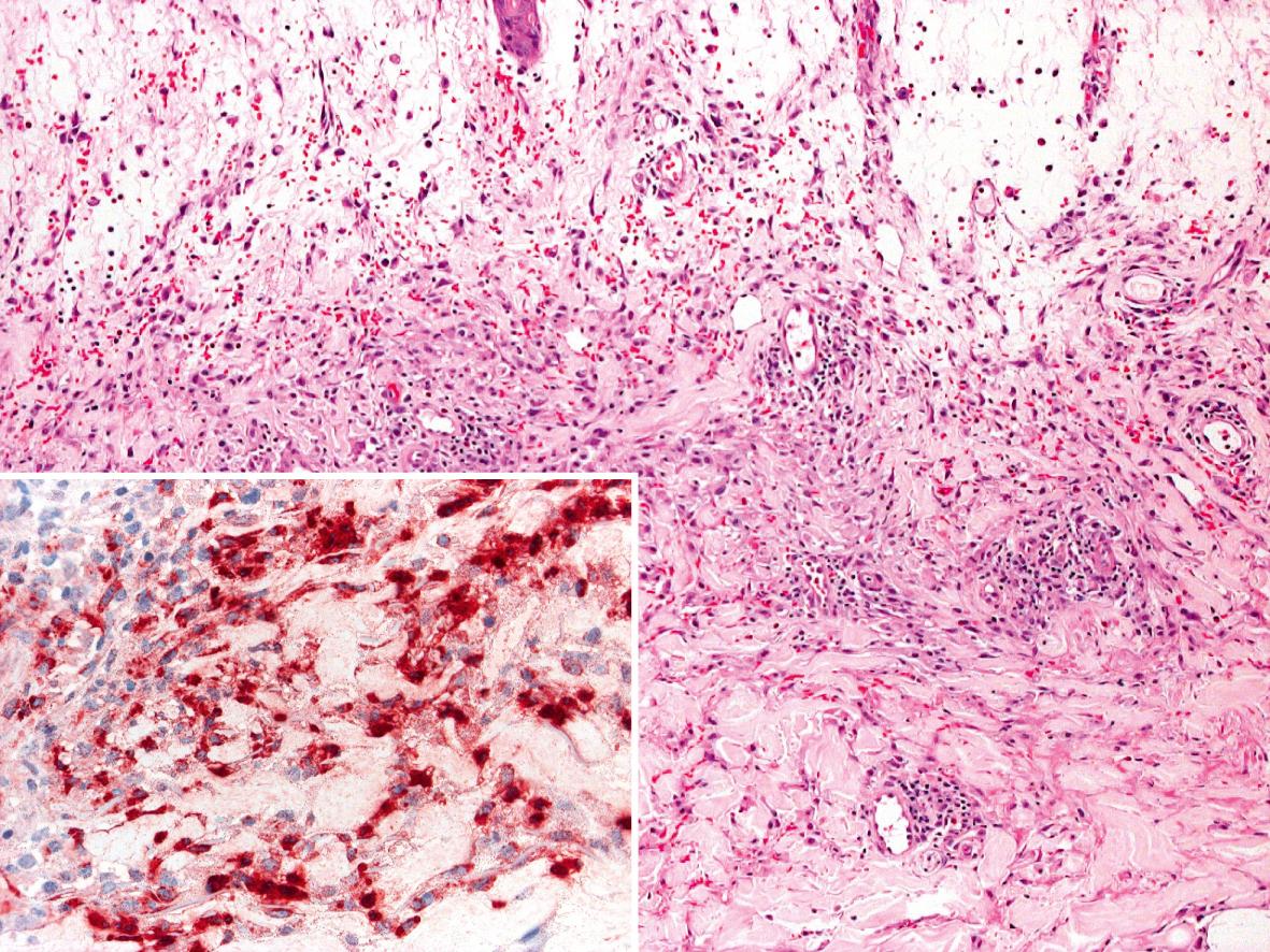 Fig. 26.6, Histiocytoid Sweet syndrome – histologic features.