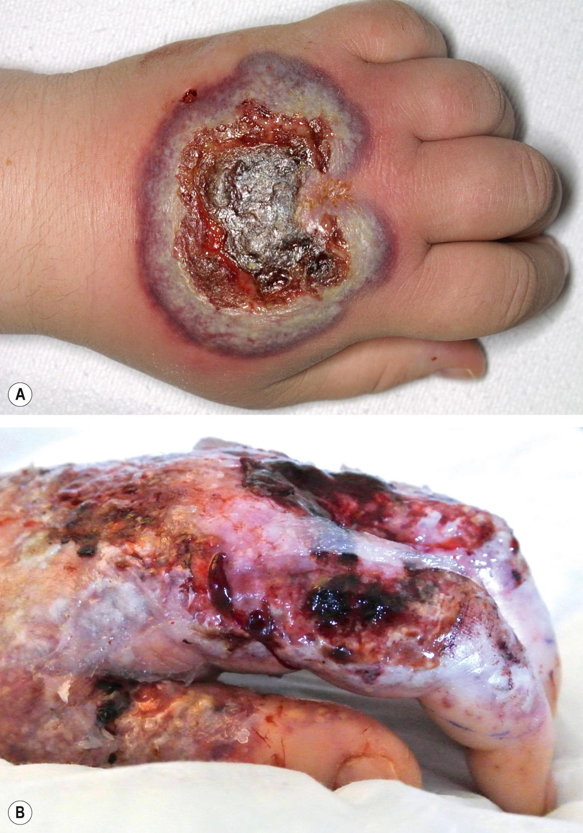 Fig. 26.7, Neutrophilic dermatosis of the dorsal hands.