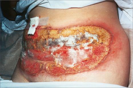 Fig. 15.1, Pyoderma gangrenosum: this unusually severe example is associated with very extensive tissue destruction resembling necrotizing fasciitis.