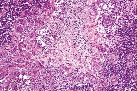 Fig. 15.11, Superficial granulomatous pyoderma: the zoned inflammatory reaction is clearly seen. Note the central abscess and surrounding granulomatous inflammation.