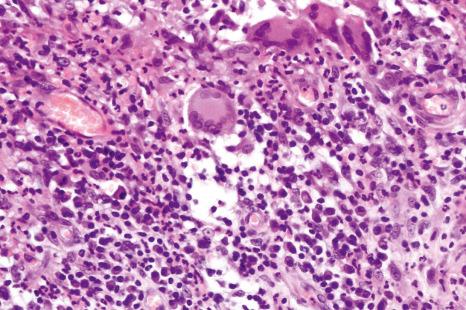 Fig. 15.12, Superficial granulomatous pyoderma: high-power view showing multinucleate giant cells. There are also conspicuous plasma cells.