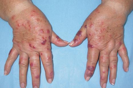 Fig. 15.16, Sweet syndrome: acral lesions on the dorsal surface of the hands and fingers, some with a hemorrhagic appearance.