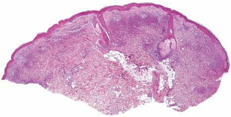 Fig. 15.17, Sweet syndrome: an intense inflammatory cell infiltrate is present in the dermis.